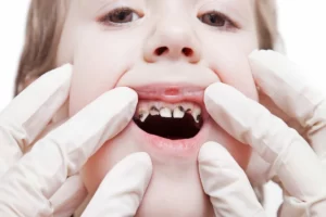 Treatment of child tooth cocoon