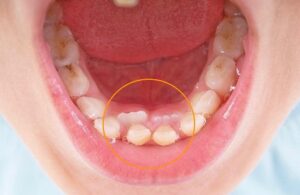 علت و‌ درمان انواع دندانهای اضافه در کودکان